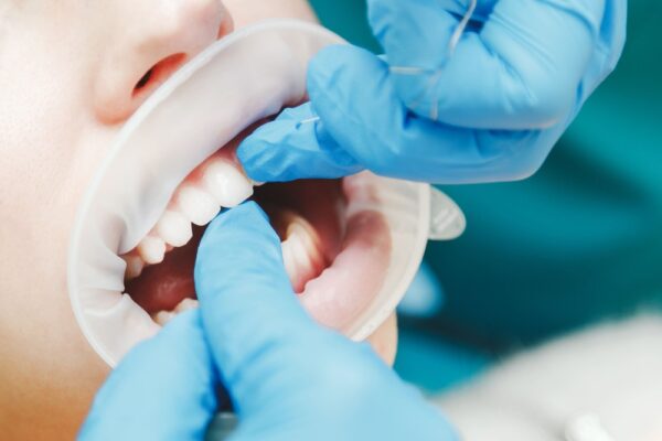 close-up-of-female-mouth-with-retractor-doctor-fl-2022-12-16-21-40-55-utc (1)