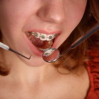 girl-teeth-braces-and-dentist-tools-2022-11-11-08-21-42-utc (1)