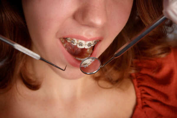 girl-teeth-braces-and-dentist-tools-2022-11-11-08-21-42-utc (1)