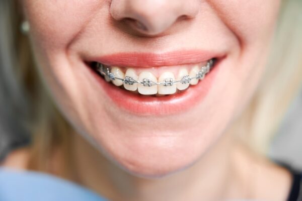 smiling-young-woman-with-braces-on-teeth-2022-05-30-22-50-19-utc (2)